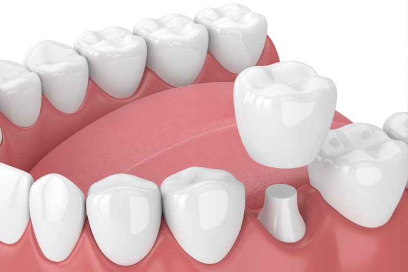 Dental Crowns in Clemmons