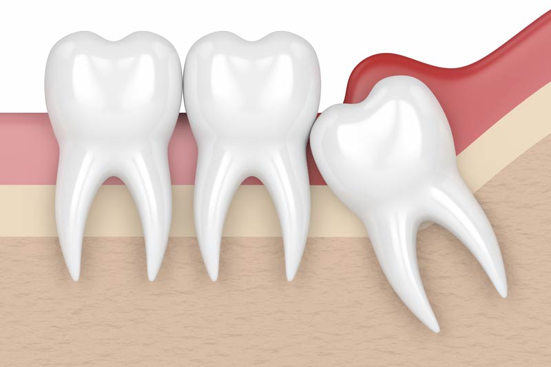 Wisdom Tooth Removal in Clemmons